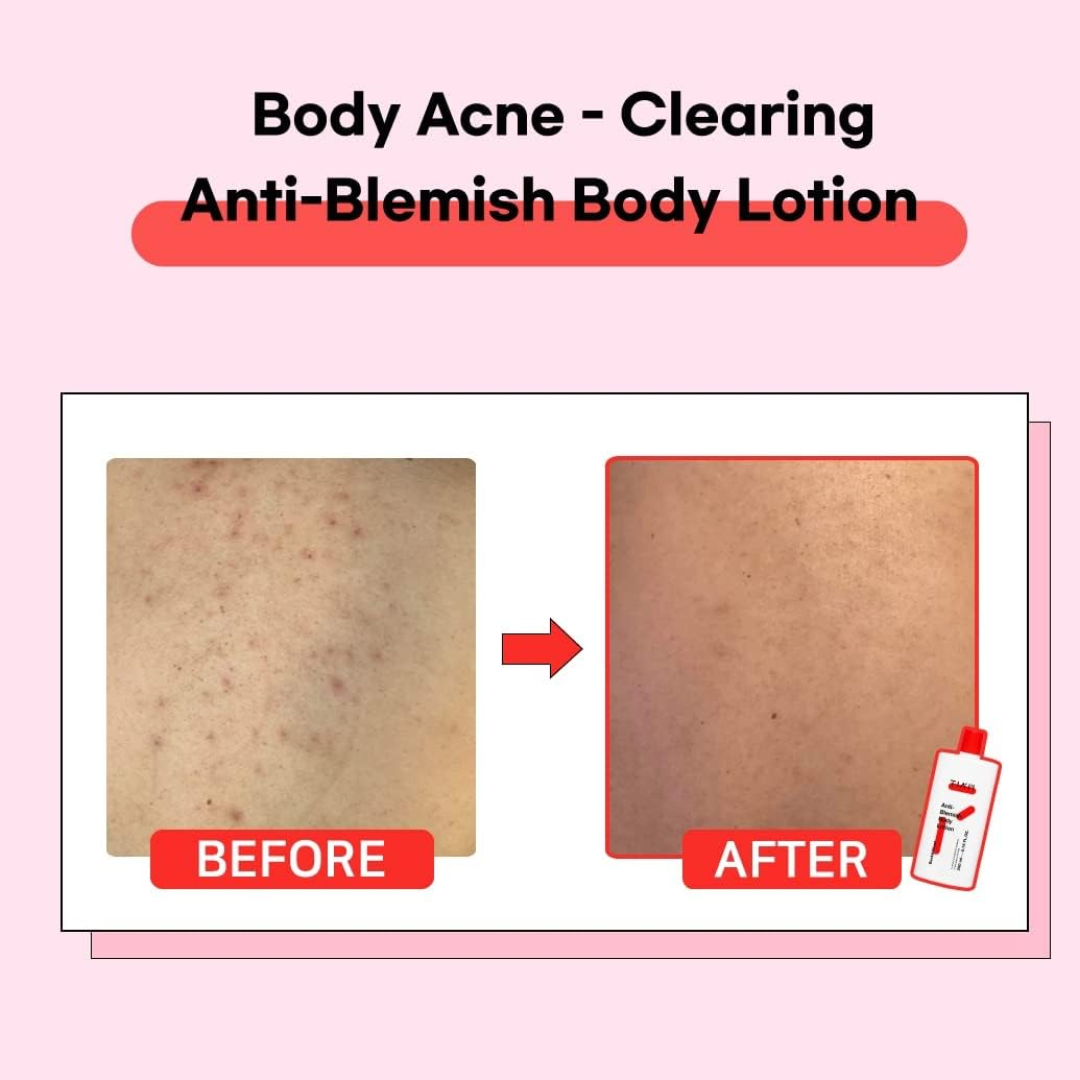 Anti Blemish Body Lotion Back & Chest
